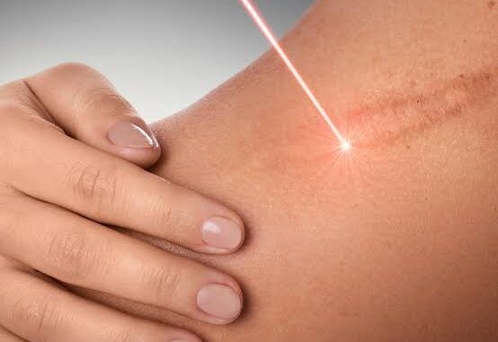 How Does Laser Scar Removal Work? Benefits, Results, and Aftercare